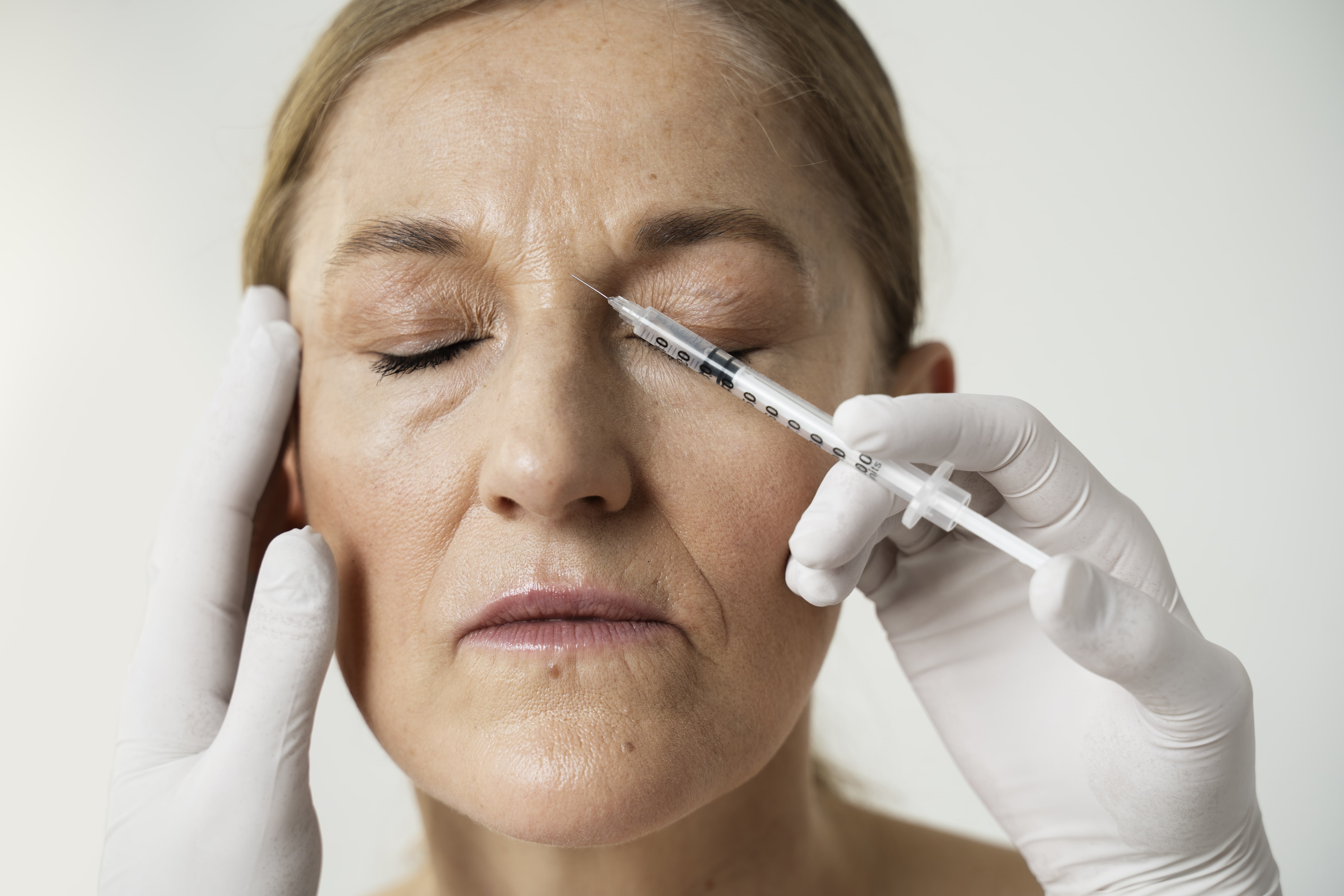 Borite se protiv bora? Hijaluron ili Botox – što odabrati?